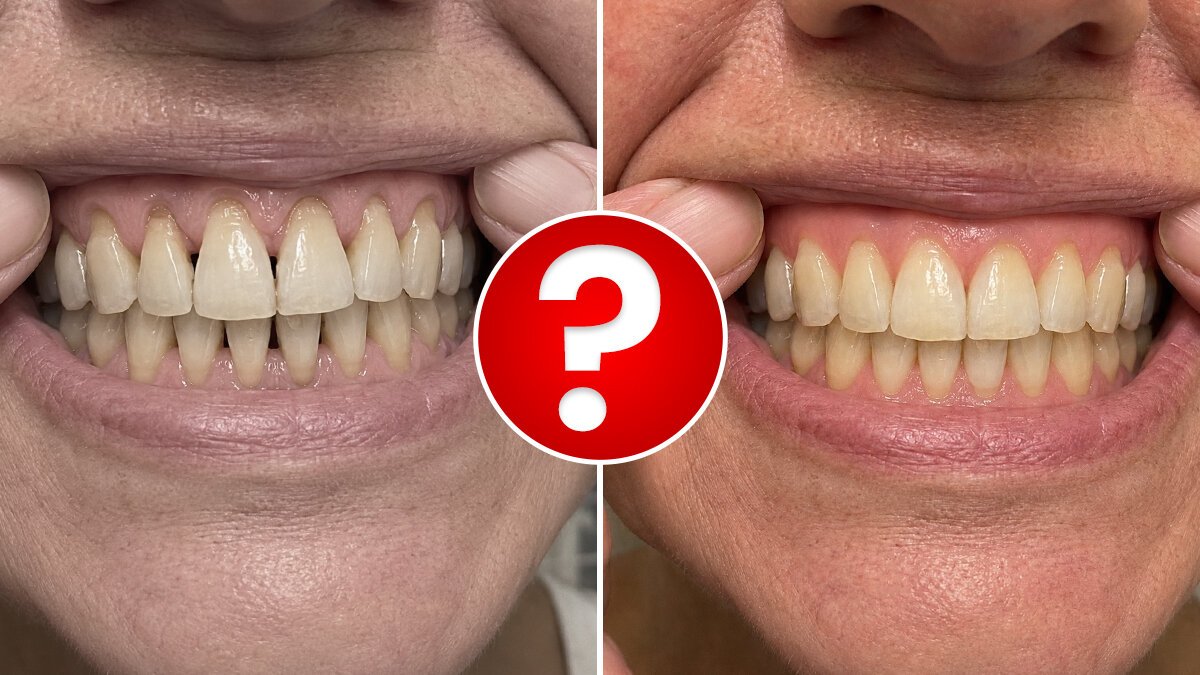 Comparison of gum and smile appearance